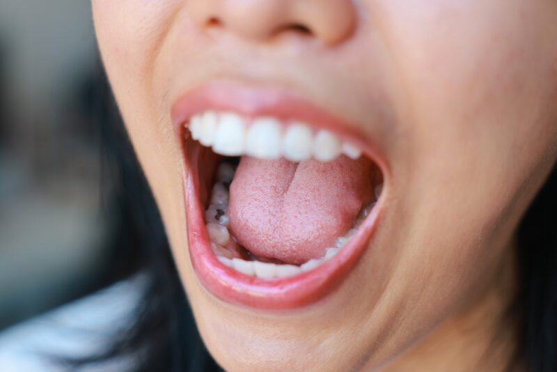 Dental Fillings Boise