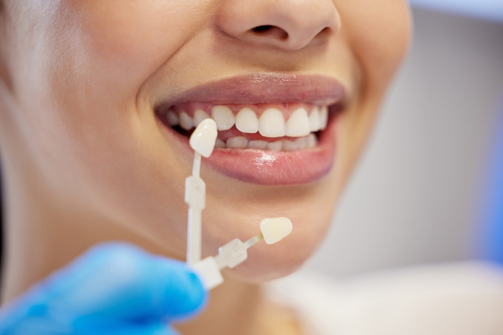 Dental Veneers in Boise